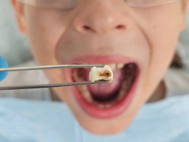 Best Chipped Tooth Repair Near Me  in La Crosse, KS